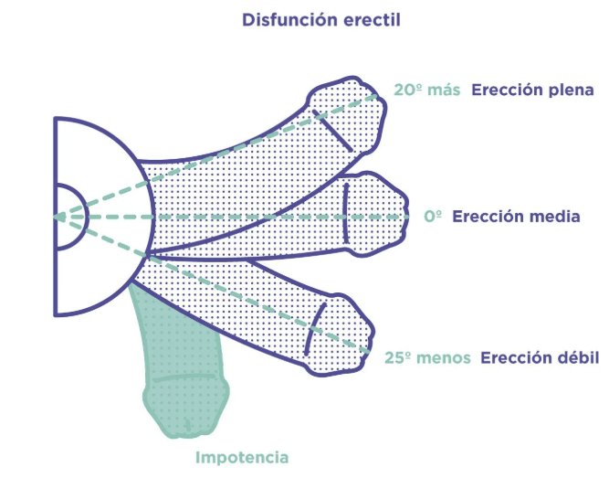disfunción eréctil soluciones